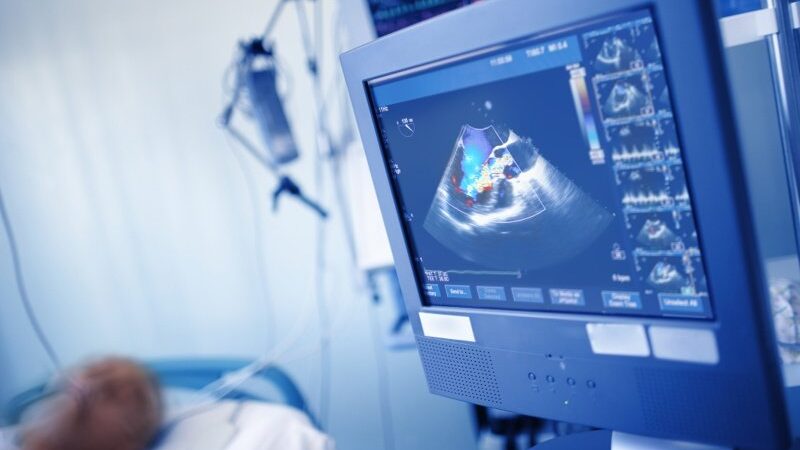 ESC 2022: UltraSight claims European approval for AI-guided heart ultrasound